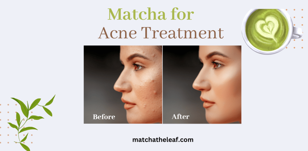 matcha tea for acne